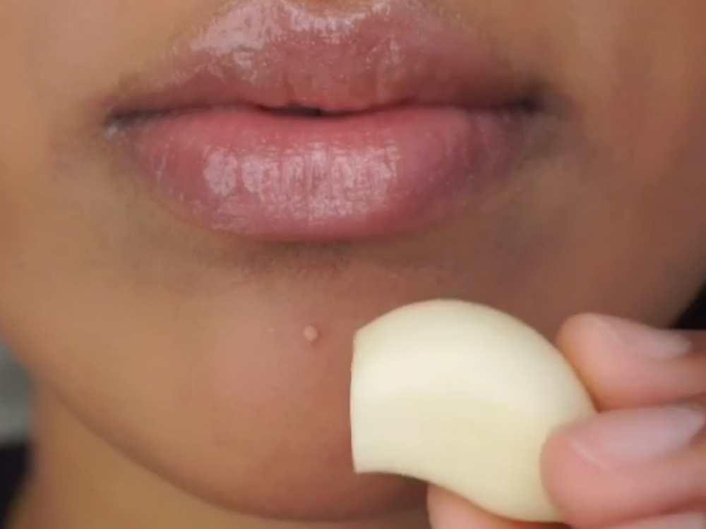 effectiveness of garlic in eliminating acne